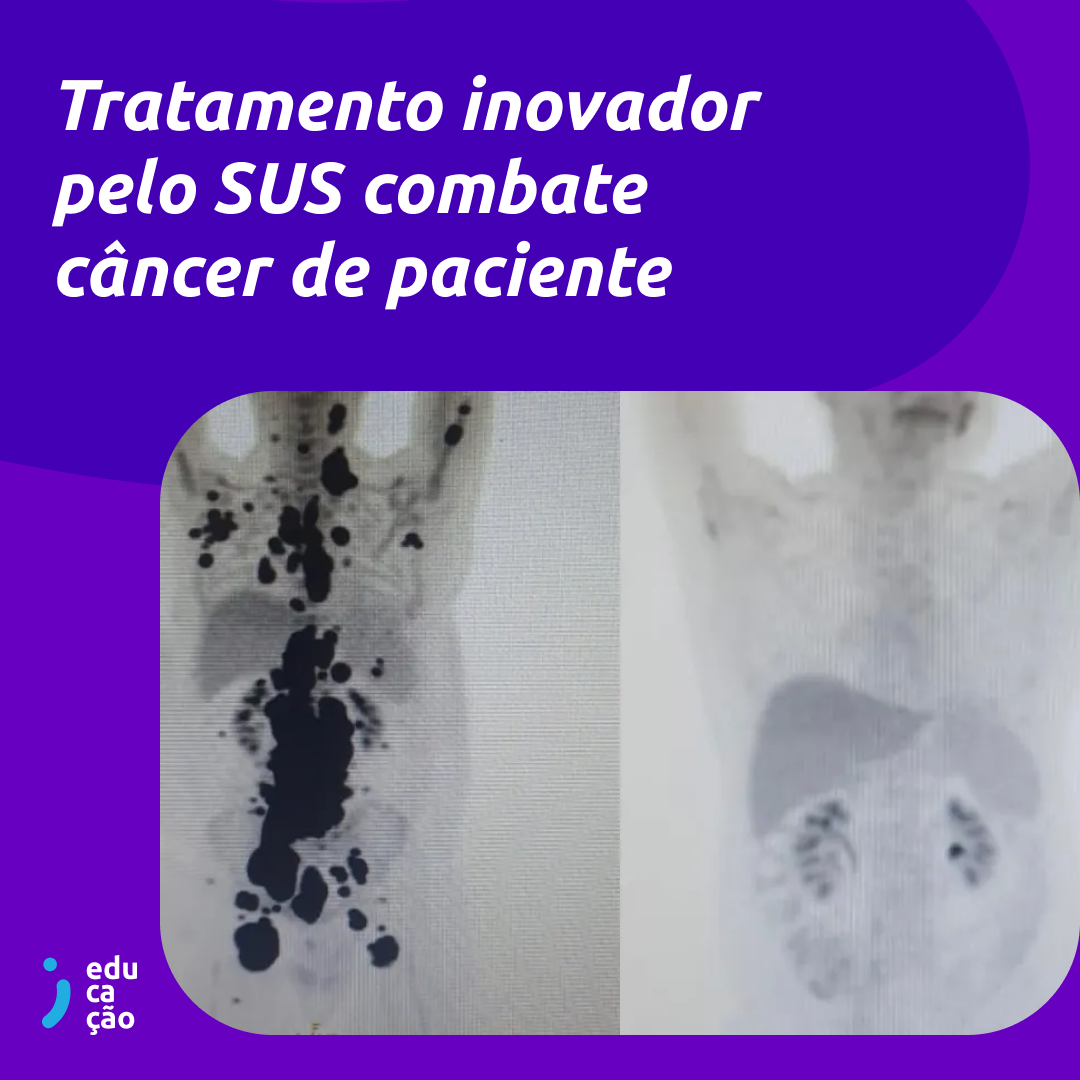 Paciente que lutava há 13 anos contra o câncer tem melhora graças a tratamento pelo SUS.